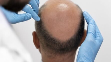 Which is the Best Hair Transplant Clinic in Hyderabad? What You Should Know Before Choosing a Clinic?